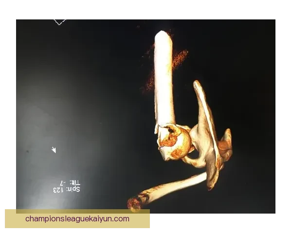 莱万多夫斯基肩伤影响状态，持续提升的可能性受到挑战